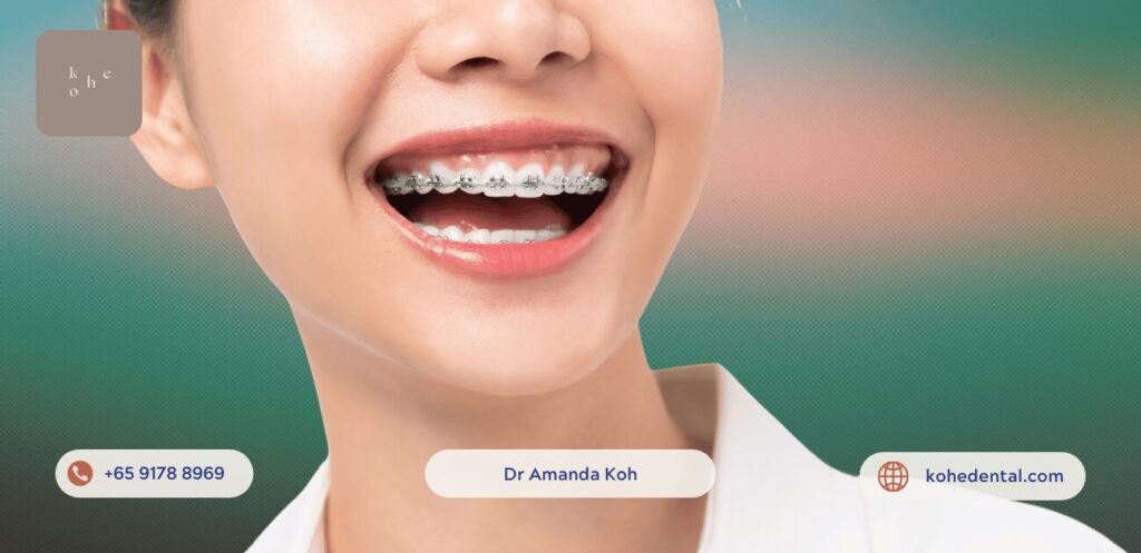Affordable Braces Hack: Straighten Teeth on A Budget 2 Affordable Metal Braces - kohe™ Dental