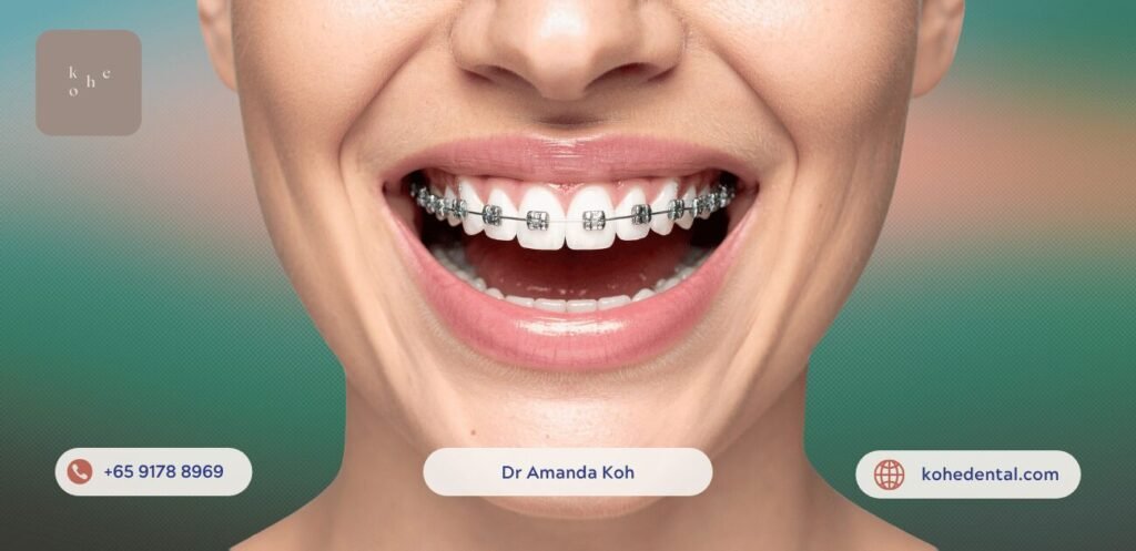 Affordable Braces Hack: Straighten Teeth on A Budget 4 Affordable Self-Ligating Braces - kohe™ Dental