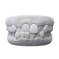 Treat Simple to Severe Cross Bite with kohe™ Dental - kohe™ Dental