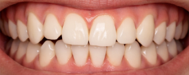 The Importance of A Realistic Budget for Clear Aligners 3 Mild Misalignment - kohe™ Dental