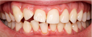 The Importance of A Realistic Budget for Clear Aligners 7 Severe Misalignment - kohe™ Dental