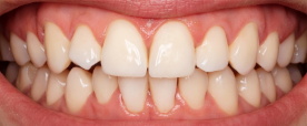 The Importance of A Realistic Budget for Clear Aligners 4 Moderate Misalignment - kohe™ Dental