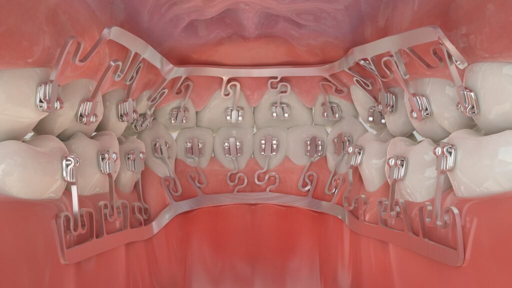 Move Teeth Fast! Brava by Brius Lingual Braces Cost + Treatment 1