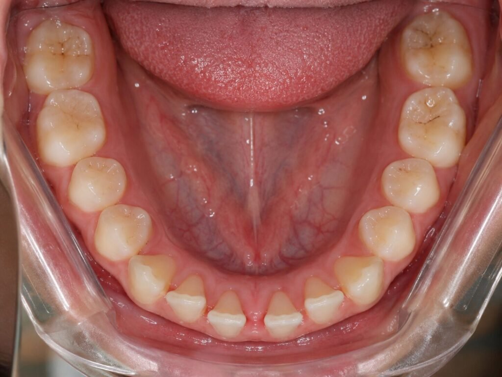 Gaps in teeth can be spotted over a clear aligner photo assessment - kohe™ Dental