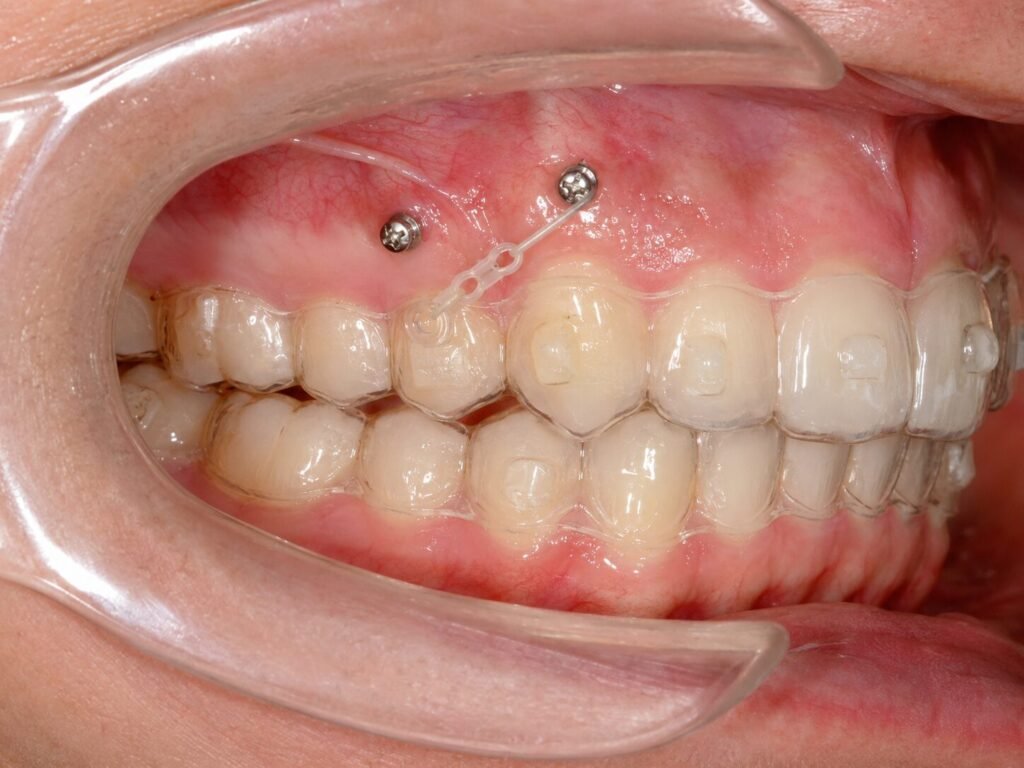 A clear aligner photo assessment can help determine whether you require further orthodontic appliances to support your clear aligner treatment - kohe™ Dental