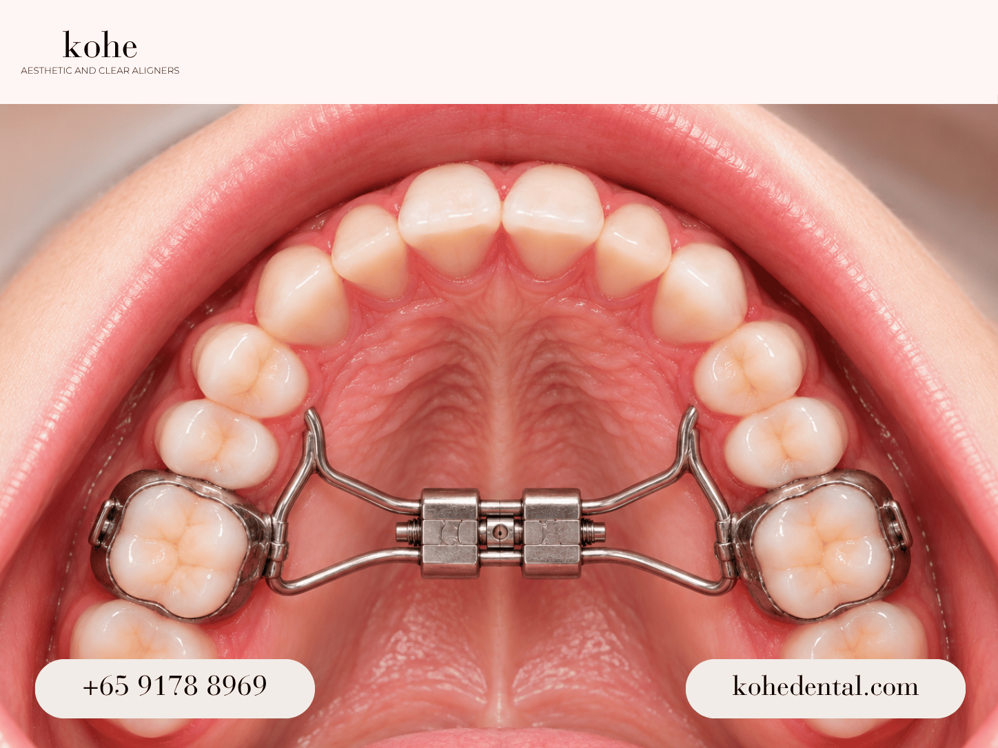Traditional Palatal Expander - kohe™ Dental