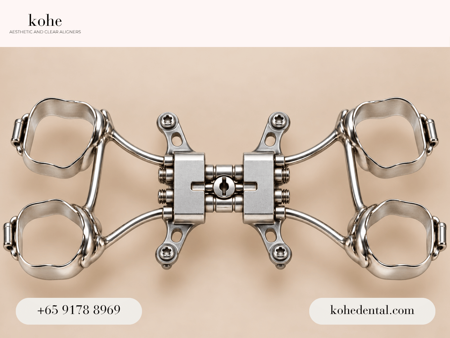 Invisalign Palatal Expander 5 MARPE device - kohe™ Dental