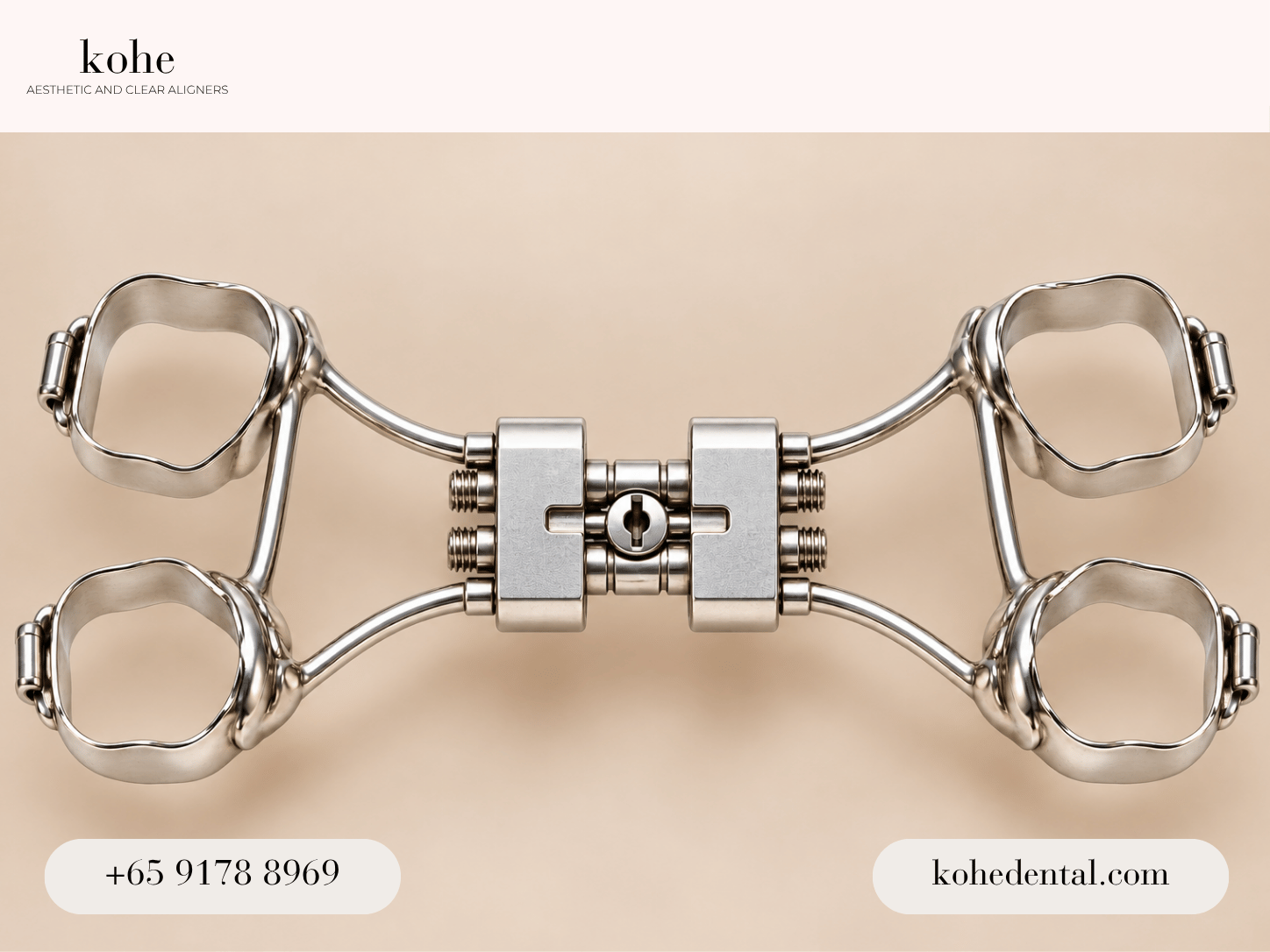 Invisalign Palatal Expander 3 RPE device - kohe™ Dental